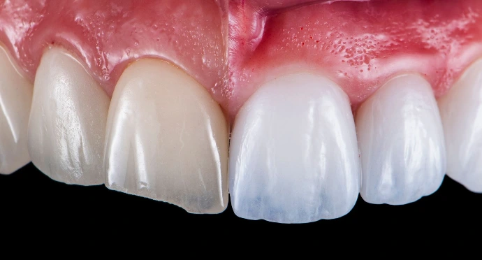 Crowns & Veneers