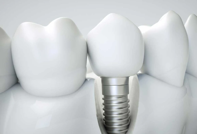 Dental Implants